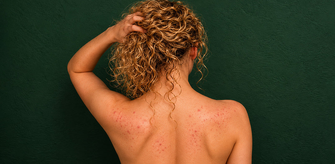 curly haired blonde with acne on bare back and shoulders shoulders standing against dark green wall