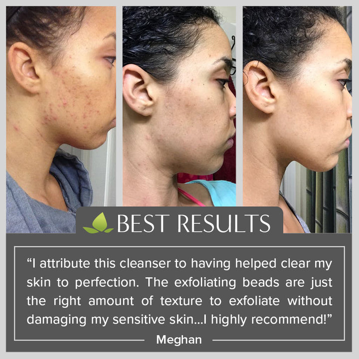 Before / After AHA/BHA Exfoliating Cleanser Acne improvement